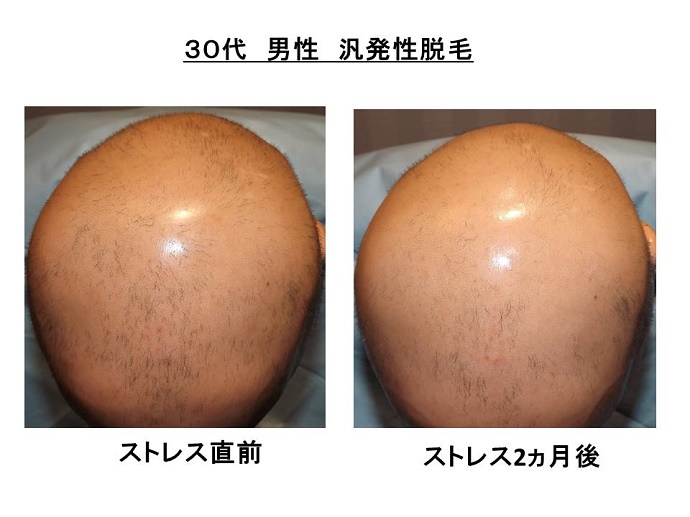 円形脱毛症　病院